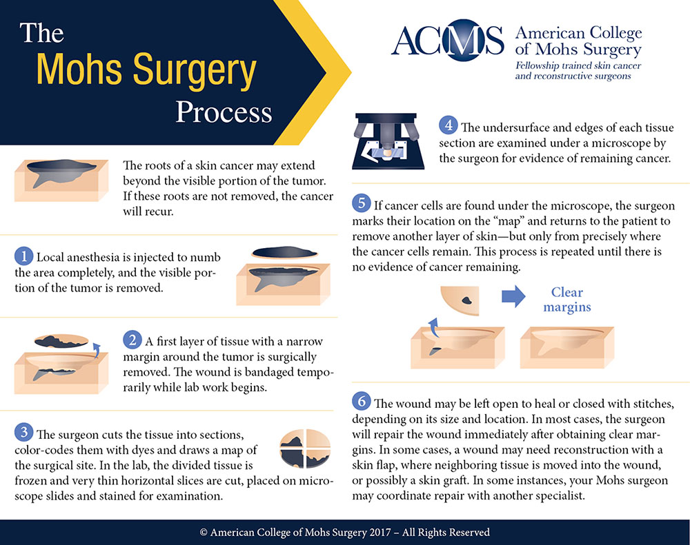 ACMS Mohs Surgery Process Infographic ACMS Mohs Surgery Process Infographic